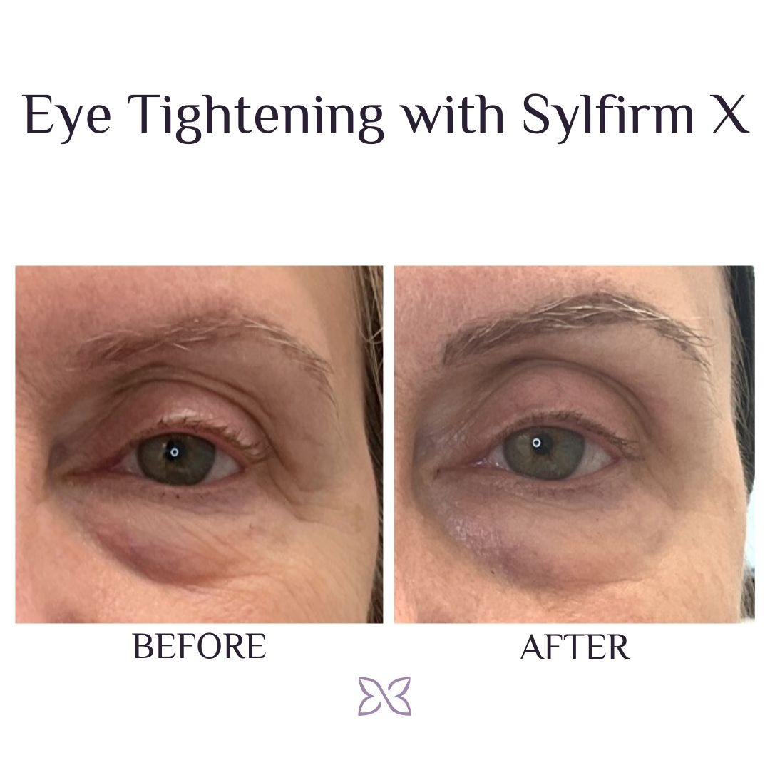 Sylfirm X vs. Morpheus 8: Unveiling the Superiority of Sylfirm X for Effective Skin Treatments
