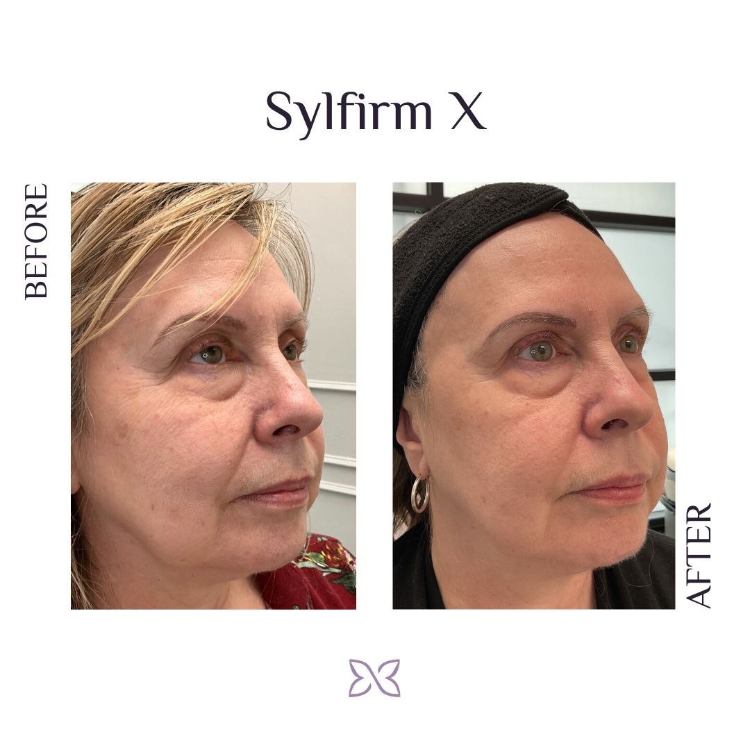 Sylfirm X vs. Morpheus 8: Unveiling the Superiority of Sylfirm X for Effective Skin Treatments