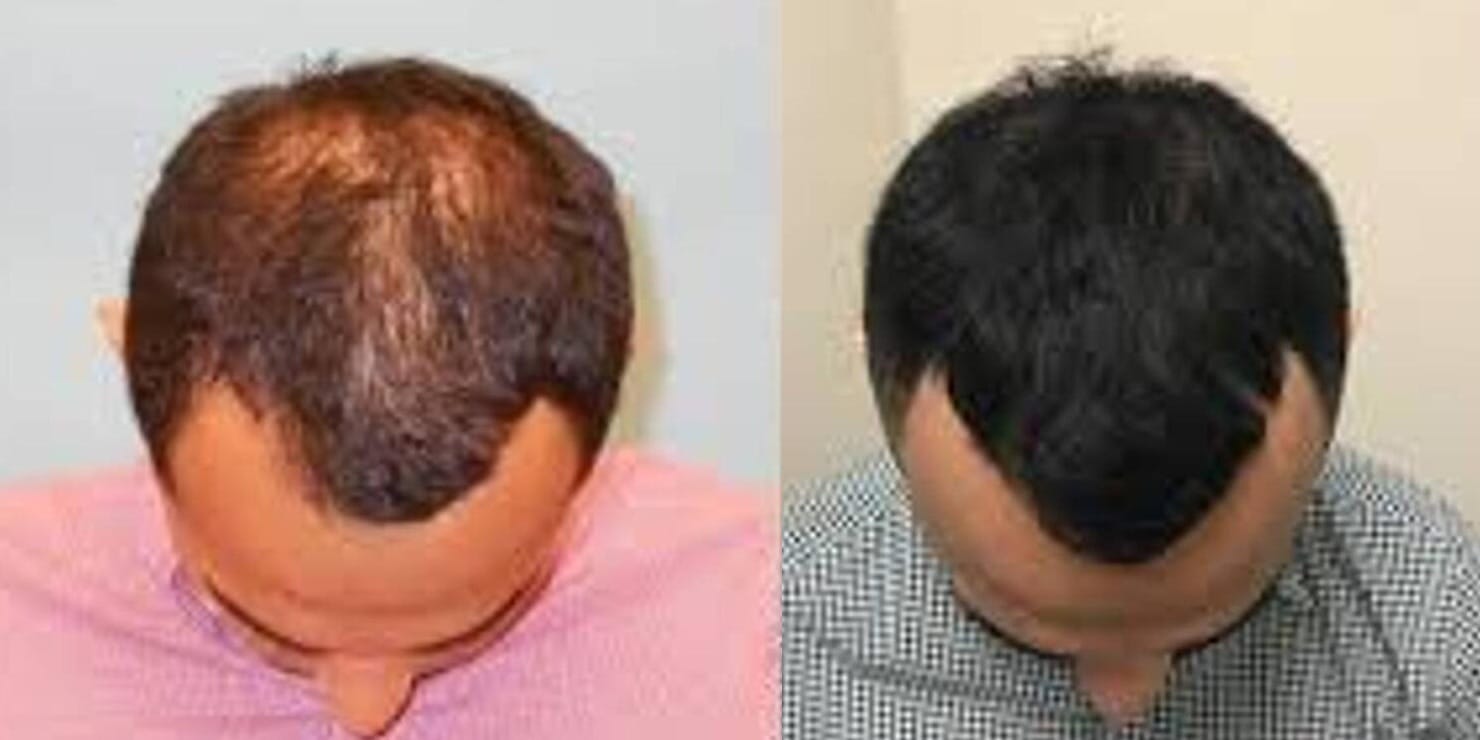 PRP Hair Restoration Before & After Image