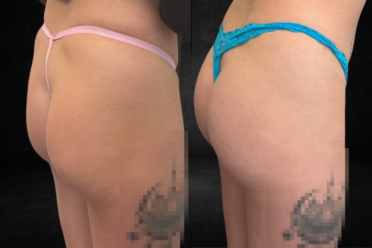 Sculptra Butt Lift Before & After Image