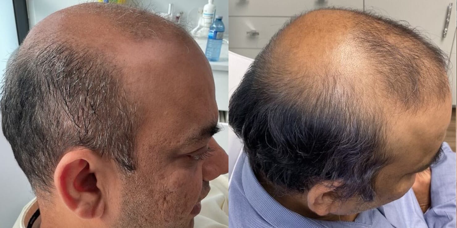 PRP Hair Restoration Before & After Image