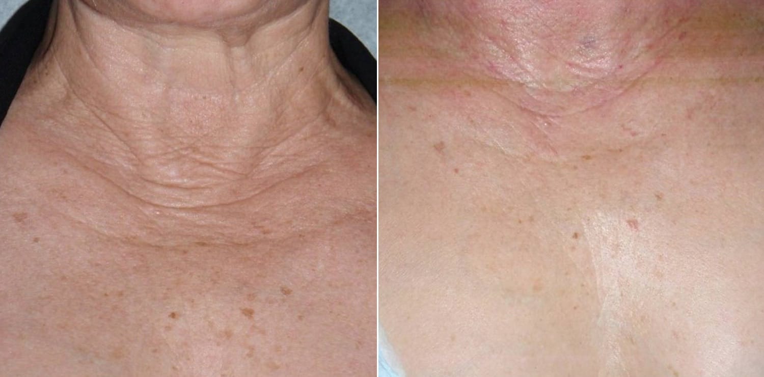 PRP Skin Treatment Before & After Image