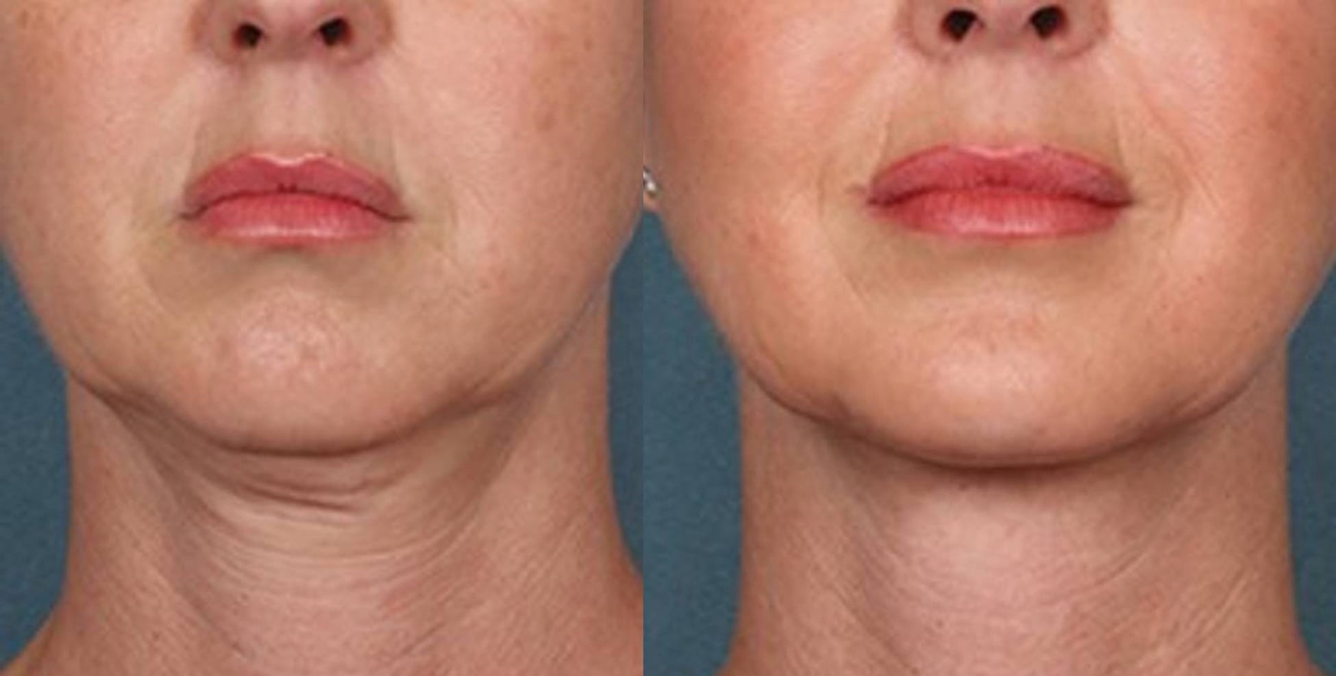 PRP Skin Treatment Before & After Image